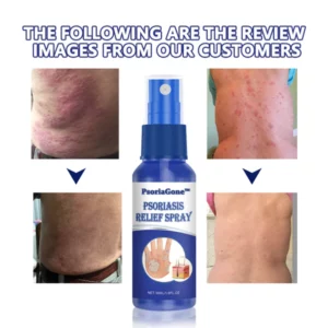 Alternative view of PsoriaGone™ Psoriasis relief spray
