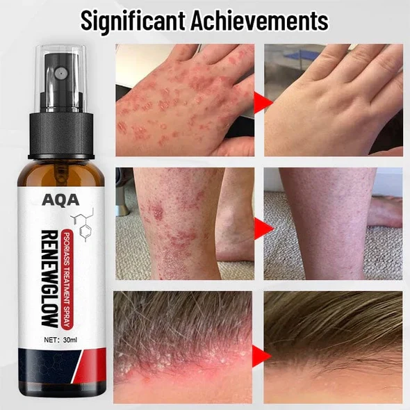 AQA™ RenewGlow Psoriasis Treatment Spray