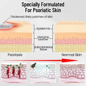 AQA™ RenewGlow Psoriasis Treatment Spray
