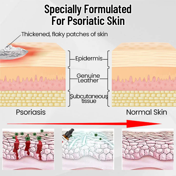 AQA™ RenewGlow Psoriasis Treatment Spray