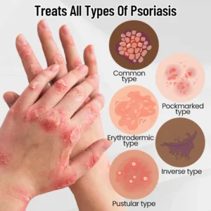 AQA™ RenewGlow Psoriasis Treatment Spray