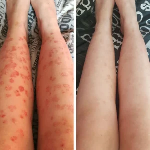 AQA™ RenewGlow Psoriasis Treatment Spray