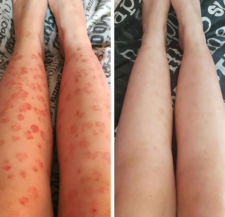 AQA™ RenewGlow Psoriasis Treatment Spray