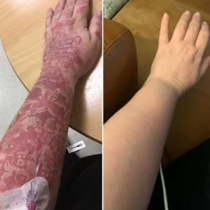 AQA™ RenewGlow Psoriasis Treatment Spray