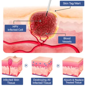 Dobshow™ Pigmaclean Skin Tip & Birthmark Remover&Upgraded Spider Poison