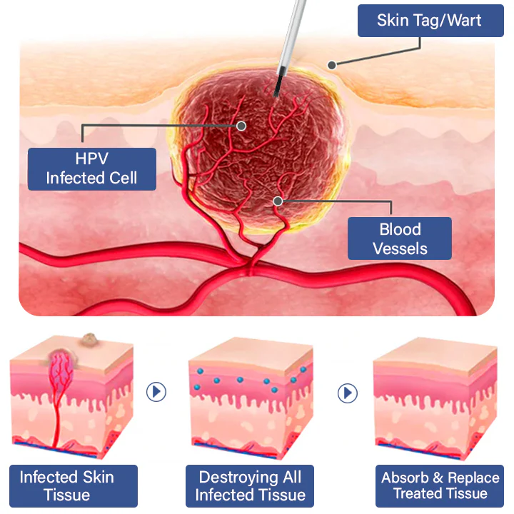 Dobshow™ Pigmaclean Skin Tip & Birthmark Remover&Upgraded Spider Poison