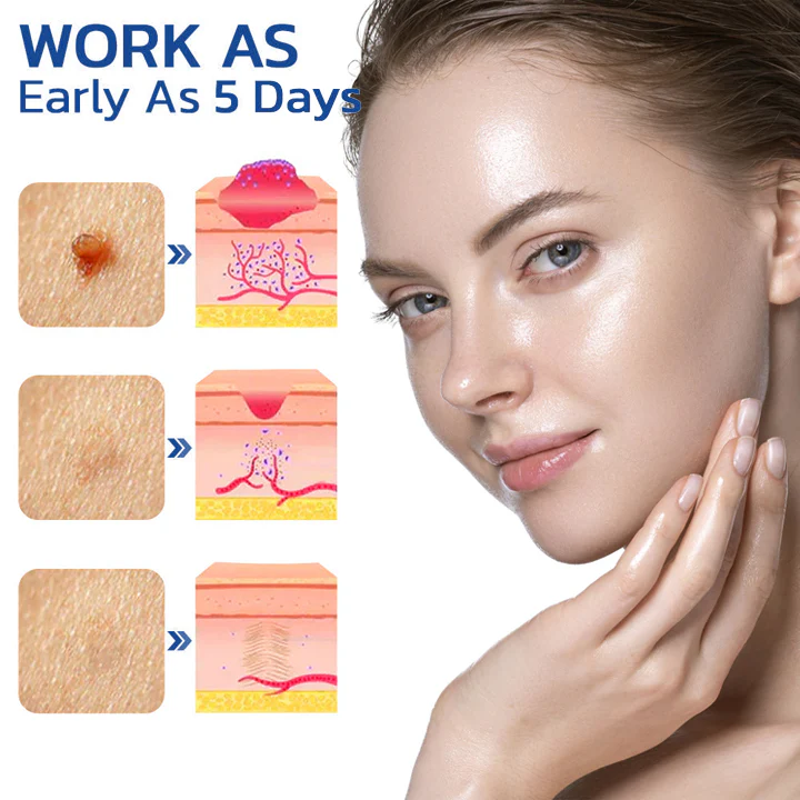 Dobshow™ Pigmaclean Skin Tip & Birthmark Remover&Upgraded Spider Poison