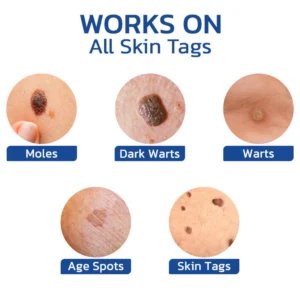 Dobshow™ Pigmaclean Skin Tip & Birthmark Remover&Upgraded Spider Poison