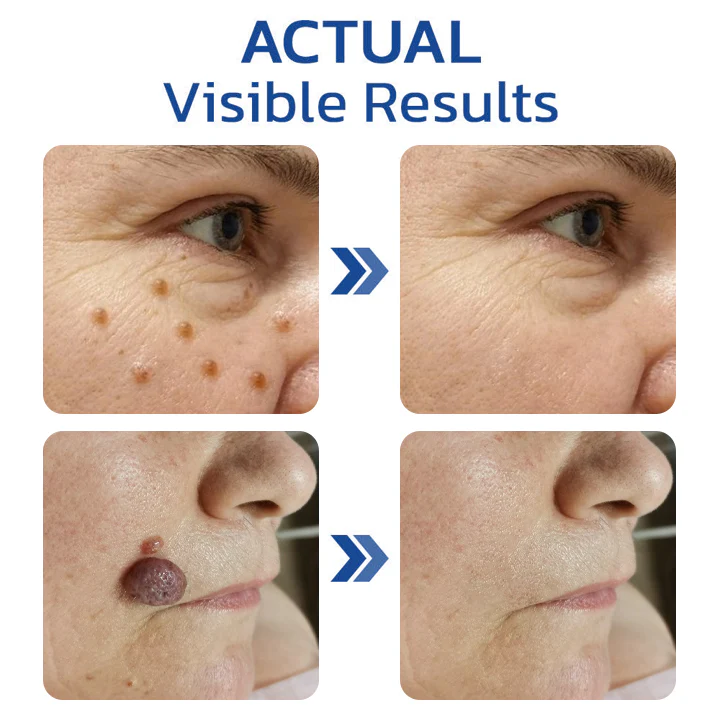 Dobshow™ Pigmaclean Skin Tip & Birthmark Remover&Upgraded Spider Poison