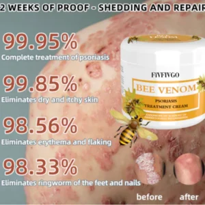 Fivfivgo™ BeeVenom Psoriasis Solution Cream