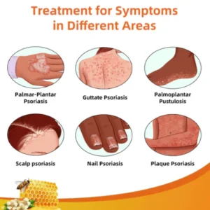 Fivfivgo™ BeeVenom Psoriasis Solution Cream