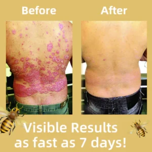 Fivfivgo™ BeeVenom Psoriasis Solution Cream