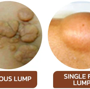 GFOUK™ Lumpless Lipoma Treatment Cream