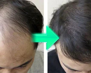 HAIRENEW™ FolliHerb Hair Growth Spray