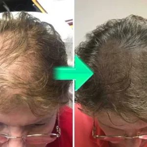 HAIRENEW™ FolliHerb Hair Growth Spray