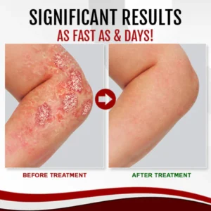 LINDO™ Psoriasis Treatment Spray