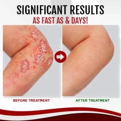 LINDO™ Psoriasis Treatment Spray