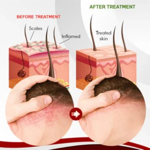 LINDO™ Psoriasis Treatment Spray