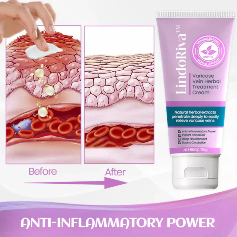 LindoRiva™ Varicose Vein Herbal Treatment Cream