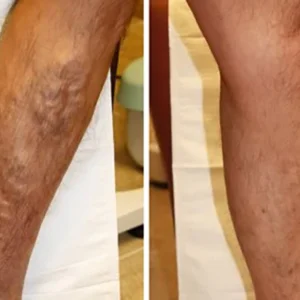 LindoRiva™ Varicose Vein Herbal Treatment Cream