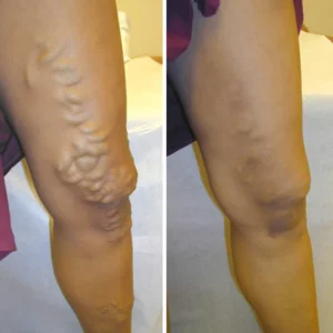 LindoRiva™ Varicose Vein Herbal Treatment Cream