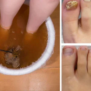 SENUIZ™ Bee Venom Nail Fungus Treatment Soak