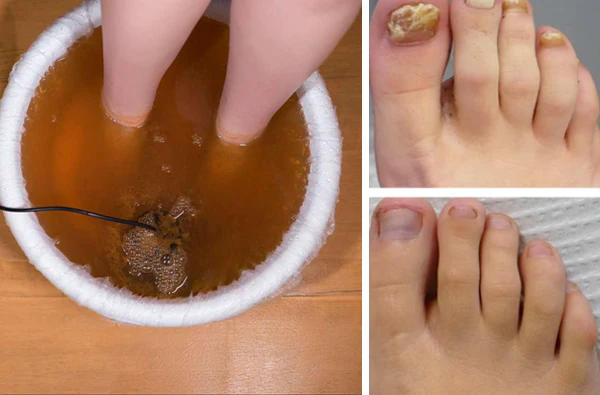 SENUIZ™ Bee Venom Nail Fungus Treatment Soak