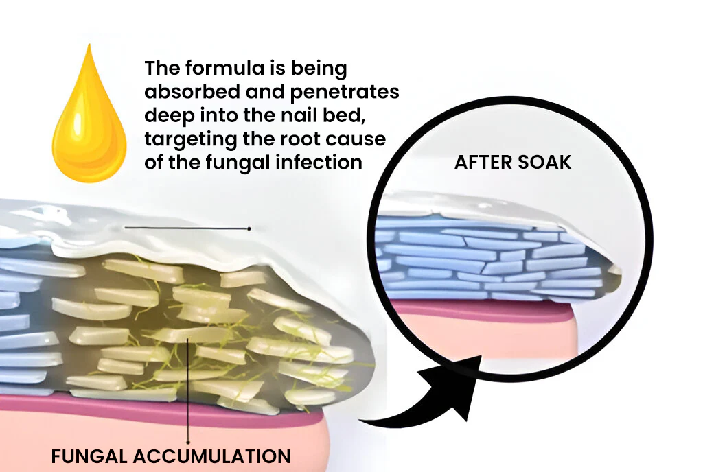 SENUIZ™ Bee Venom Nail Fungus Treatment Soak