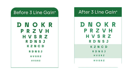 Seurico™ Eye Drops for Presbyopia Rehabilitation