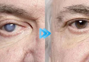 Seurico™ Myopia Reversal Eye Drops