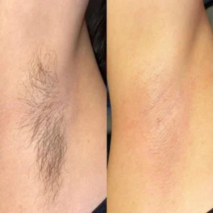 Unpree™ BeeMousse Hair Removal