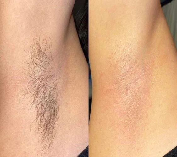Unpree™ BeeMousse Hair Removal
