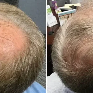 Unpree™ Hair Density Boost Capsules