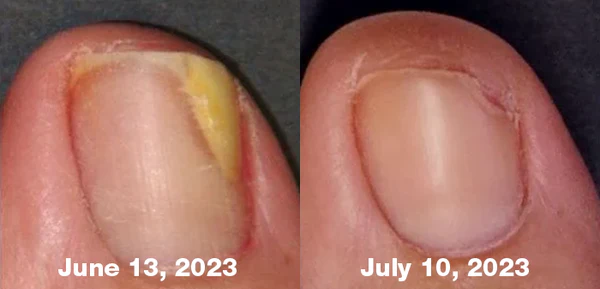flysmus™ FungiFree Bee Venom Nail Treatment Serum