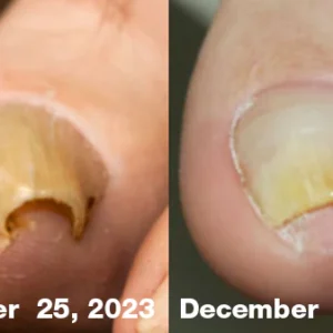 LOVILDS™ FungiFree Bee Venom Nail Treatment Serum