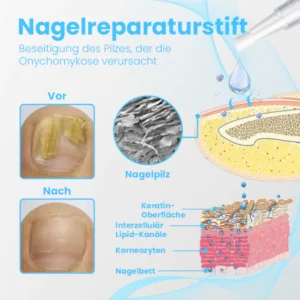Ceoerty™ FungiGuard Nagellaser-Therapiegerät