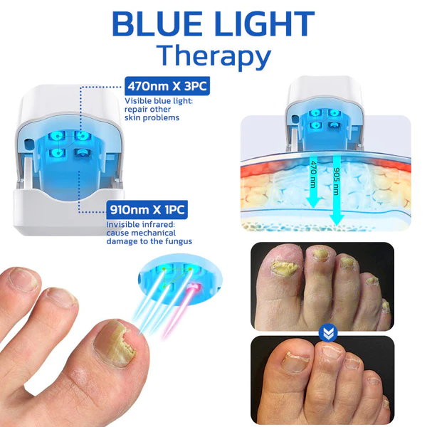 GFOUK™ FungusOFF Nail Laser Treatment Device - Image 2