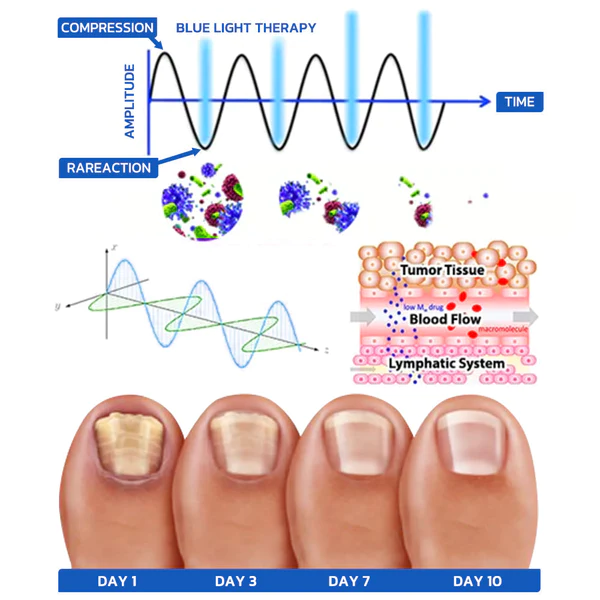 GFOUK™ FungusOFF Nail Laser Treatment Device - Image 3