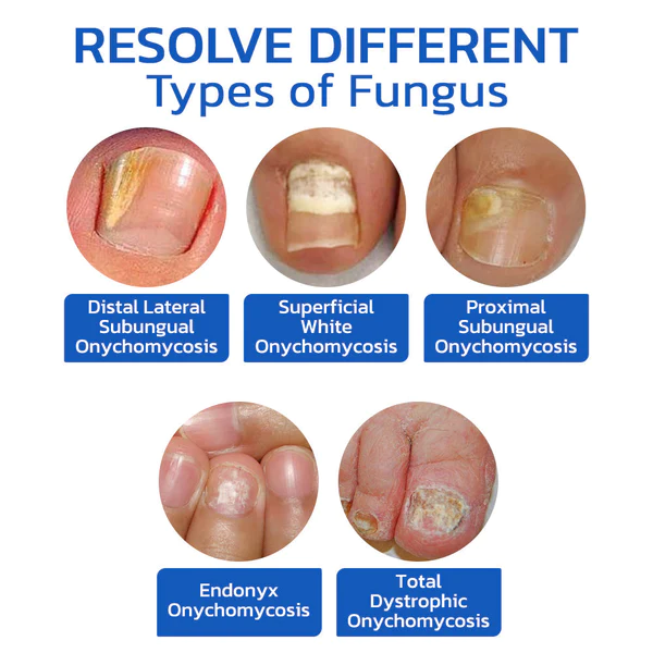 GFOUK™ FungusOFF Nail Laser Treatment Device - Image 6