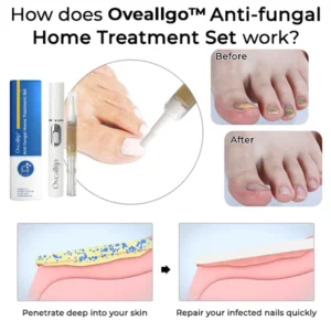 Oveallgo™ Anti-fungal Home Treatment Set