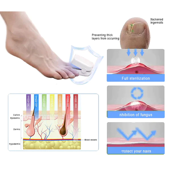 Oveallgo™ ProX Revolutionary High-Efficiency Light Therapy Device For Toenail Diseases