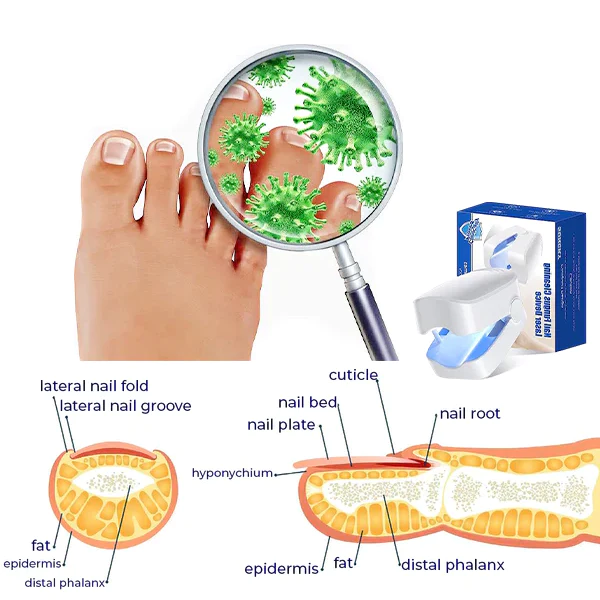 Oveallgo™ ProX Revolutionary High-Efficiency Light Therapy Device For Toenail Diseases