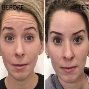 ROZINO™ 30 Days Advanced Collagen Boost Anti-Aging Botox Face Serum