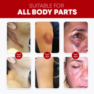 SOUTH MOON™ Herbal Bruise Fixer Spray