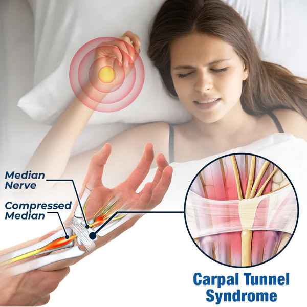 GFOUK™ NerveEase Carpal Tunnel Treatment Device - Image 2