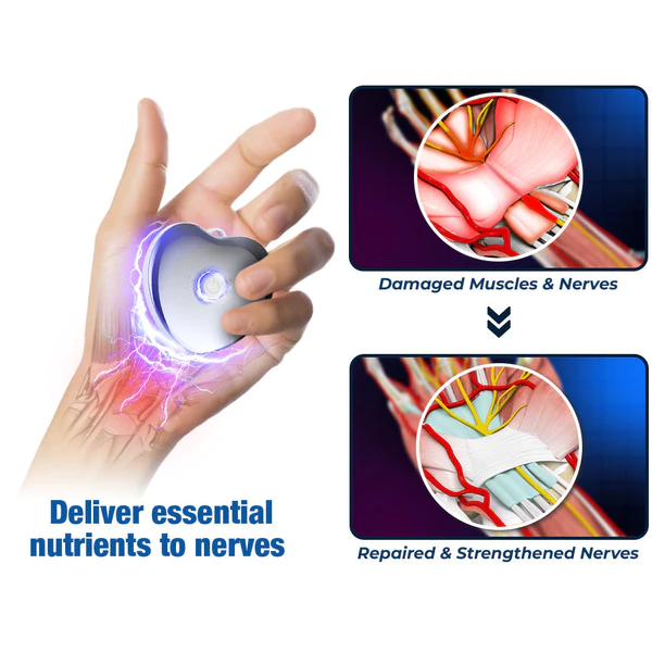 GFOUK™ NerveEase Carpal Tunnel Treatment Device - Image 3