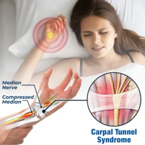 Alternative view of GFOUK™ NerveEase Karpaltunnel-Behandlungsgerät