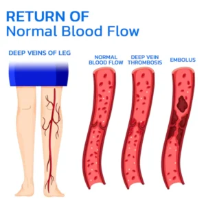 Alternative view of GFOUK™ Varicesness Treatment Patch