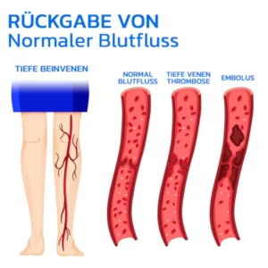 Alternative view of GFOUK™ Varizen Behandlungspflaster