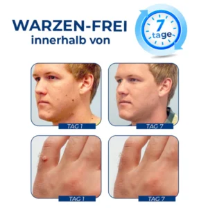 Alternative view of GFOUK™ WartsClean Creme zur Beseitigung von Warzen